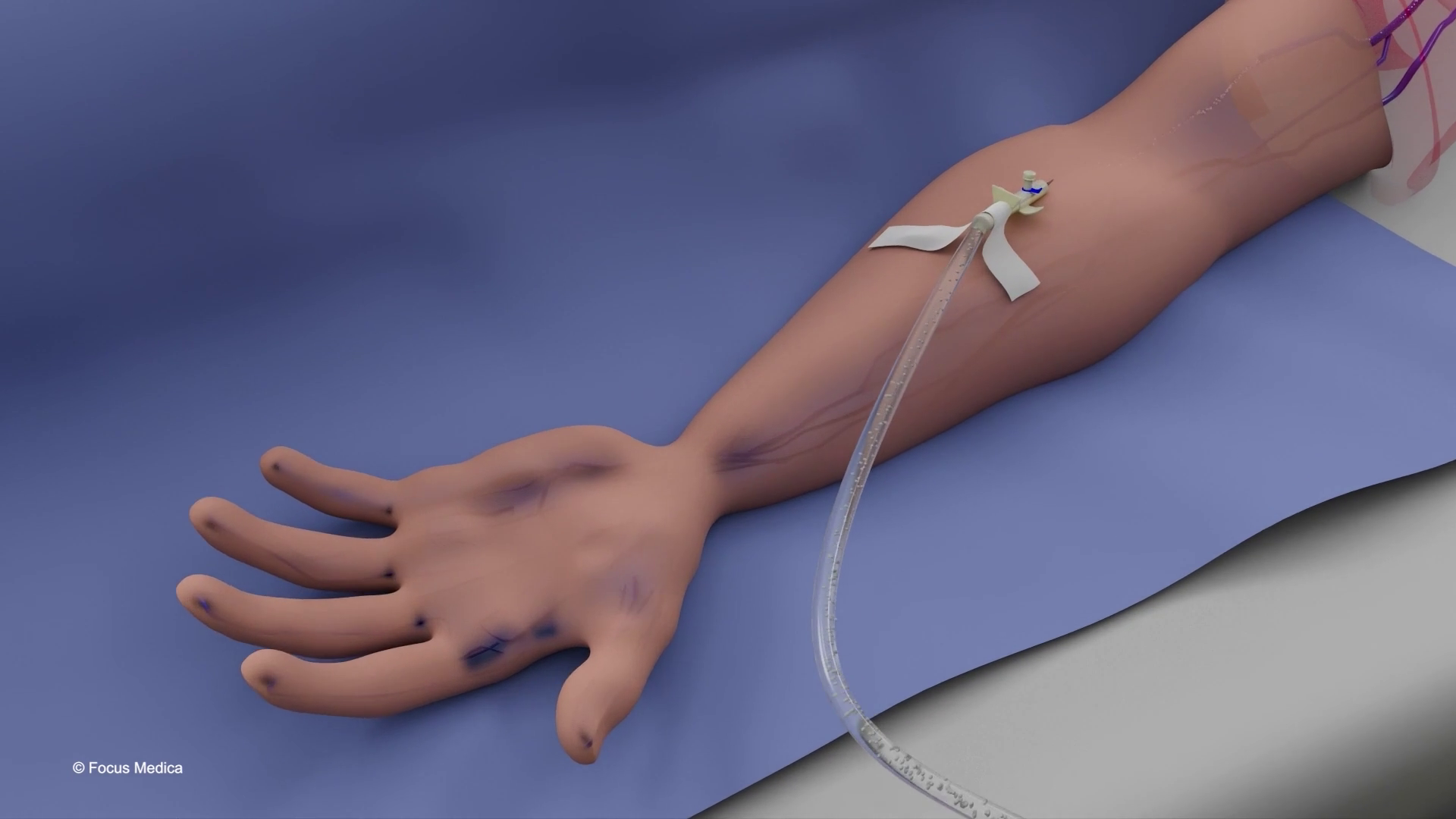 IV Therapy and its uses