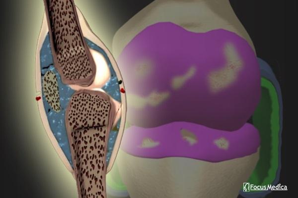 Rheumatoid arthritis