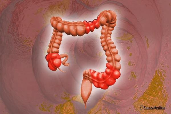 Ulcerative colitis