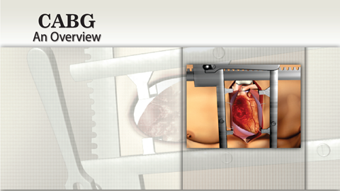 Coronary Artery Bypass Graft