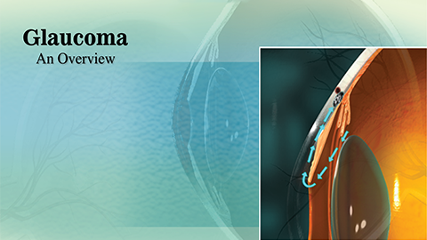 Glaucoma