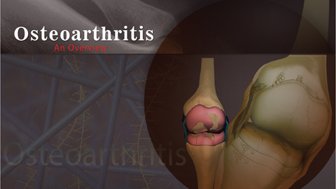 Osteoarthritis