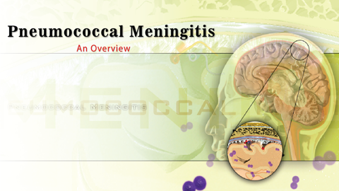 Pneumococcal meningitis