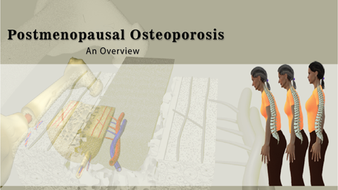 Postmenopausal Osteoporosis