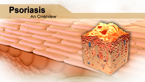 Psoriasis