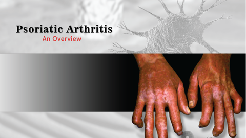 Psoriatic Arthritis