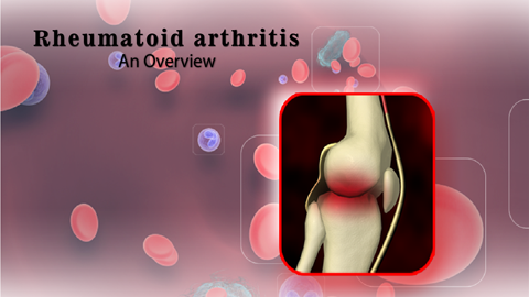 Rheumatoid Arthritis