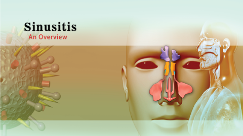 Sinusitis