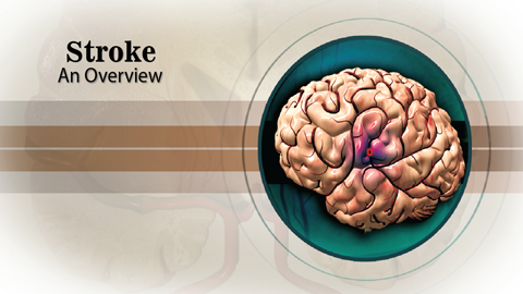 Stroke