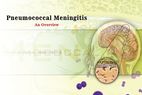 PneumococcalManengitis