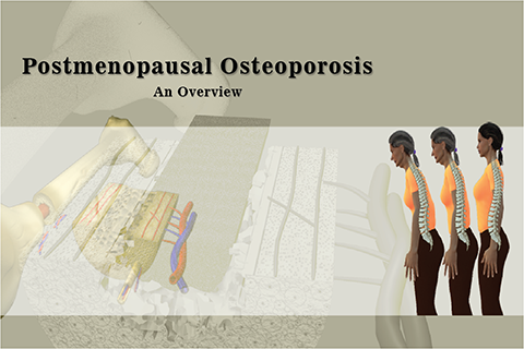 PostmenopuaseOsteoporosis