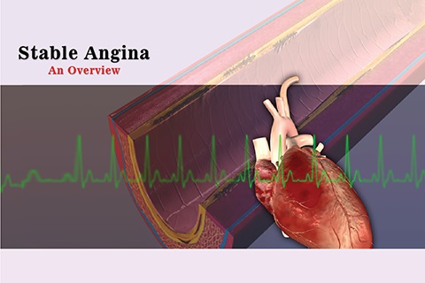 Stable-angina-poster