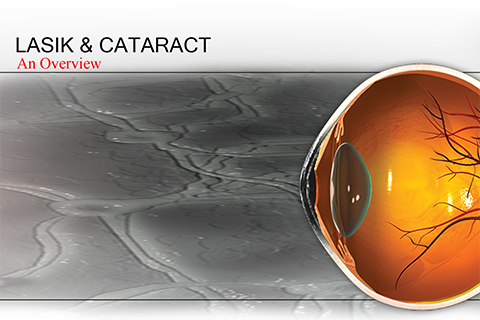 lasik & cataract